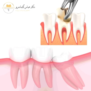 پوسیدگی دندان