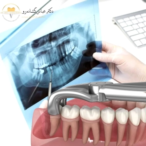 کشیدن دندان عقل روی عصب