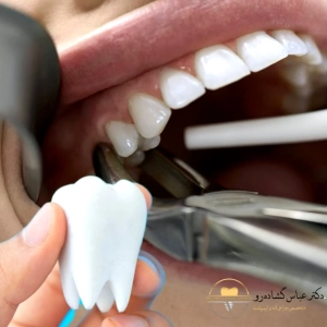 آیا کشیدن دندان های نهفته دردناک است؟