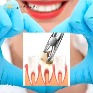 خطرات و عوارض کشیدن دندان عقل کدامند؟