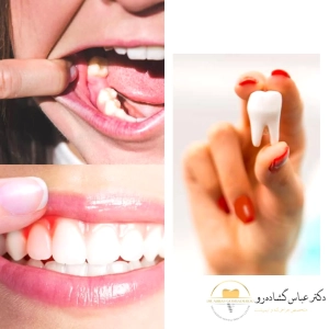 اگر دندان عقل نهفته را نکشید چه اتفاقی می افتد؟