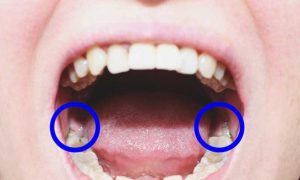 دندان عقل نهفته چیست؟