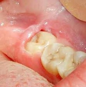 فلپ لثه روی دندان یا اپرکولوم دندان چیست؟