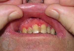 چه چیزی باعث درد لثه بین دندان ها می شود؟