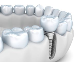 عوامل مؤثر بر طول عمر ایمپلنت های دندانی