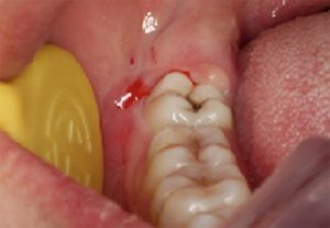 درمان اپرکولوم دندان