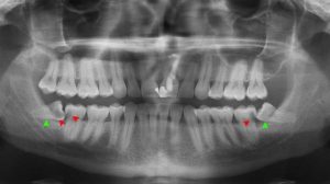 خطرات و عوارض کشیدن دندان عقل کدامند؟