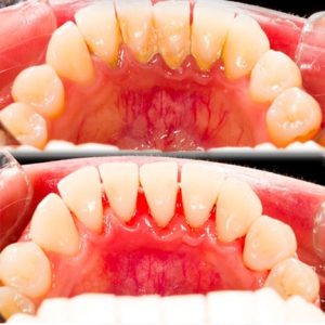 برای جلوگیری از درد لثه های بین دندان ها چه کاری می توان انجام داد؟