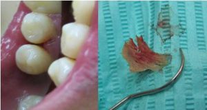 درمان های طبیعی برای تسکین درد لثه بین دندان ها