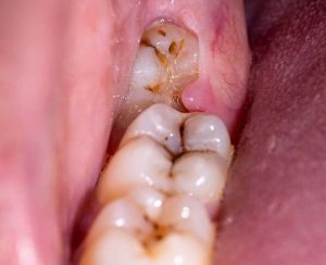 چه زمانی باید از دندان عقل نهفته مراقبت کرد؟