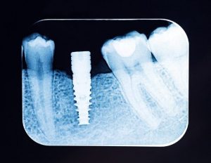 بلافاصله پس از مداخله جراحی