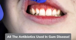 بیماری لثه ناشی از عفونت چگونه شکل می گیرد؟