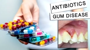 آیا آنتی بیوتیک راه حل اصلی درمان بیماری لثه است؟