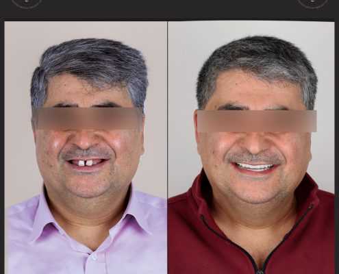 نکات مهم پیش از تصمیم‌گیری برای کاشت ایمپلنت 🦷