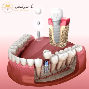 عامل اول: تراکم و کیفیت استخوان فک