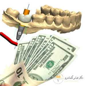 آیا قیمت ایمپلنت دیجیتال توجیه‌پذیر است؟