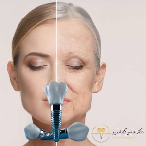 آیا ایمپلنت دیجیتال برای همه افراد مناسب است؟