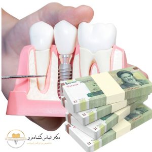 آیا هزینه ایمپلنت دندان اقساطی هم امکانپذیر است؟