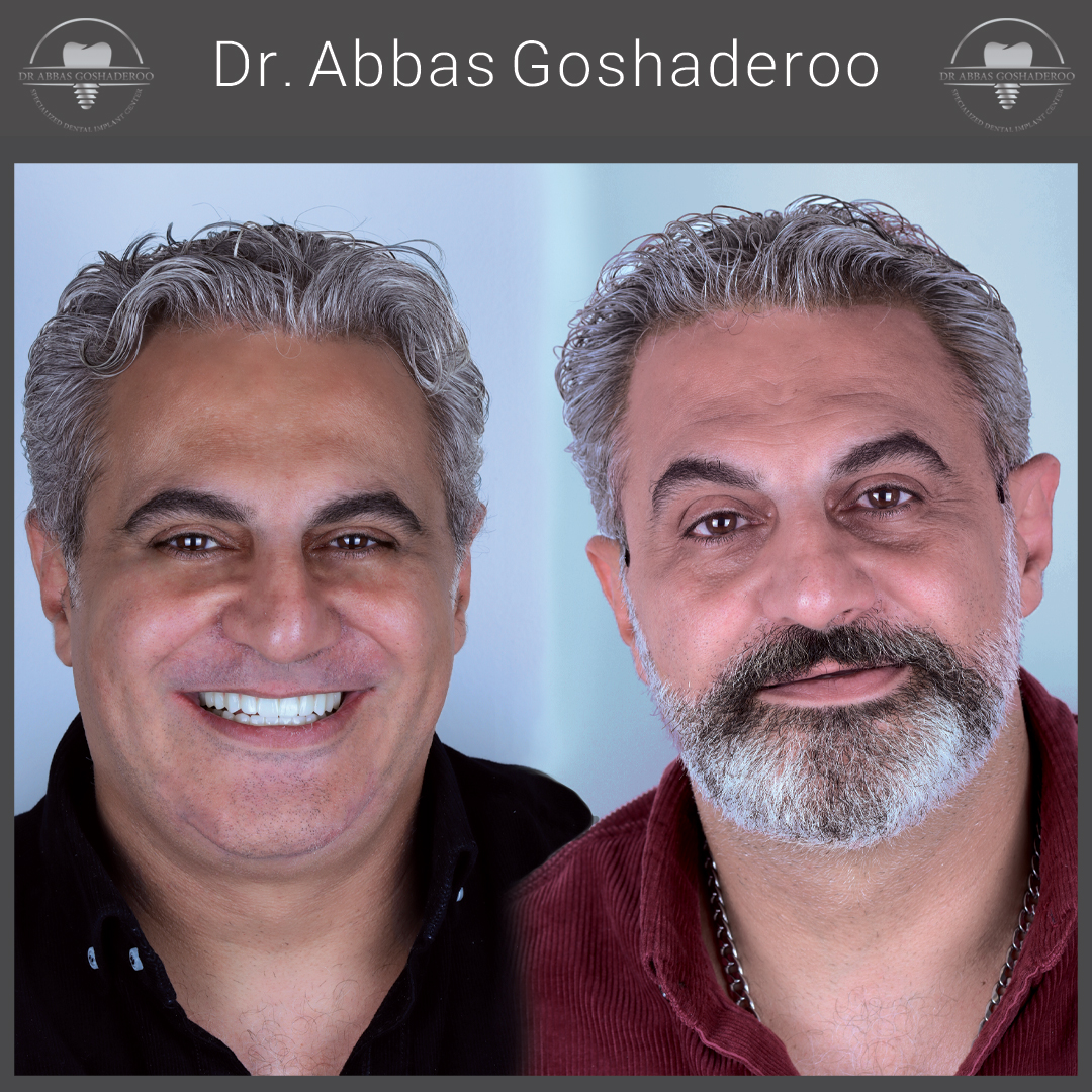 after full face together۱