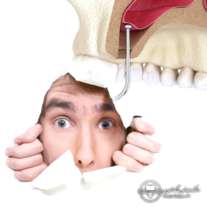 آیا جراحی سینوس لیفت درد دارد؟