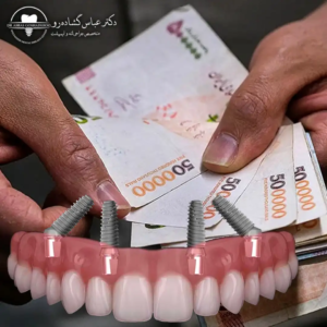 آیا قیمت همیشه معیار درستی برای انتخاب ایمپلنت است؟