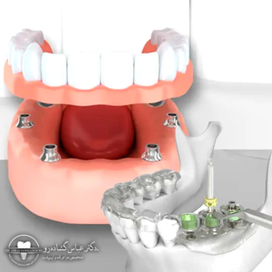 مزایای تکنولوژی دیجیتال در ایمپلنت