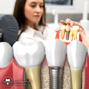 چرا مهارت جراح ایمپلنت روی موفقیت درمان تاثیر مستقیم دارد؟