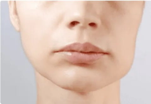 چرا تورم صورت پس از ایمپلنت های دندانی رخ می دهد؟